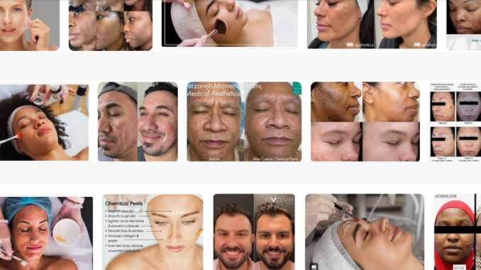 Chemical Peels Chemical Peels